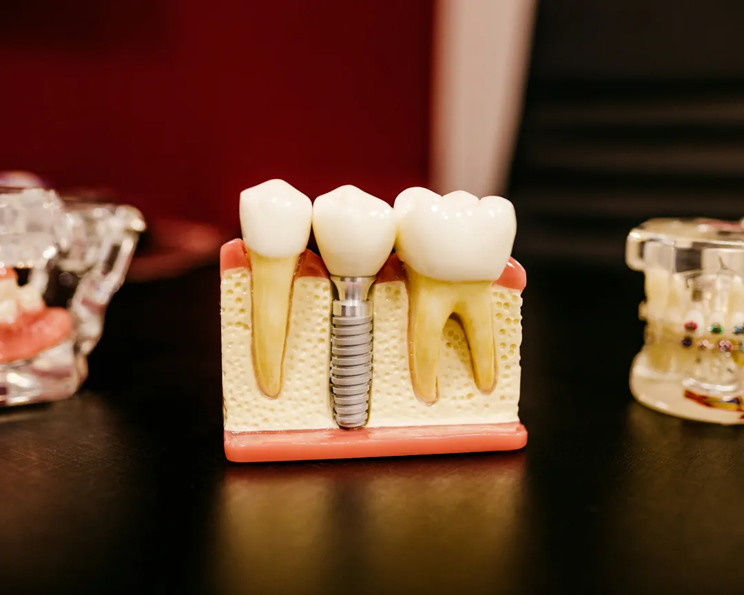 A dental model showing an implant crown between natural teeth