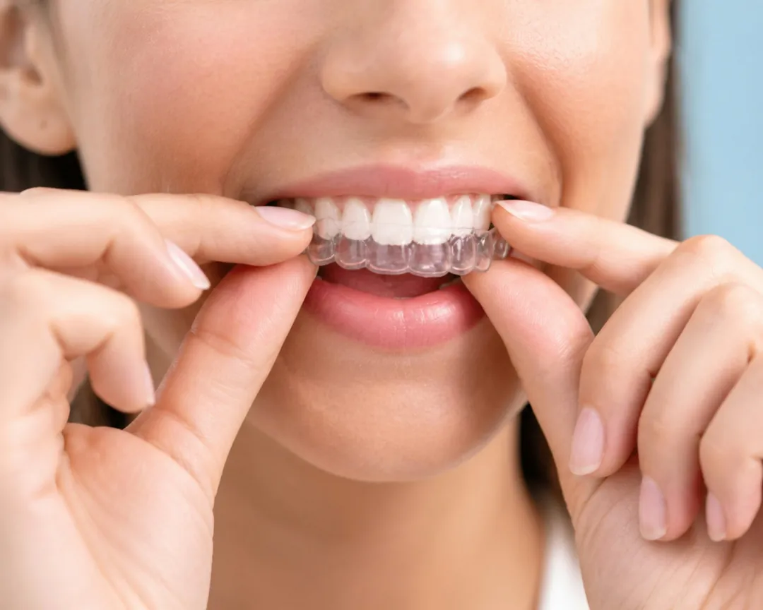 A patient fitting a clear aligner over their teeth